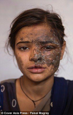 印度20岁女孩举报父亲拐卖妇女 被父亲泼硫酸毁容