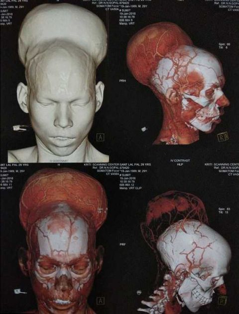 "世界最大脑瘤"被切,印度男子头顶近4斤肿瘤生活3年