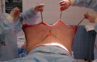 慎入:恐怖的整形吸脂手术实拍全程