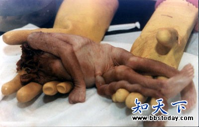 胆小者慎入!打胎后胎儿的真实照片