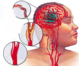 脑血管病治疗的革命性进展