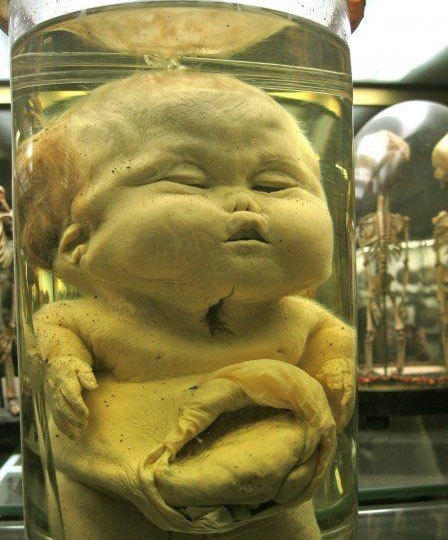 巴黎的杜普伊特伦博物馆展出各种医学畸形儿的尸体.
