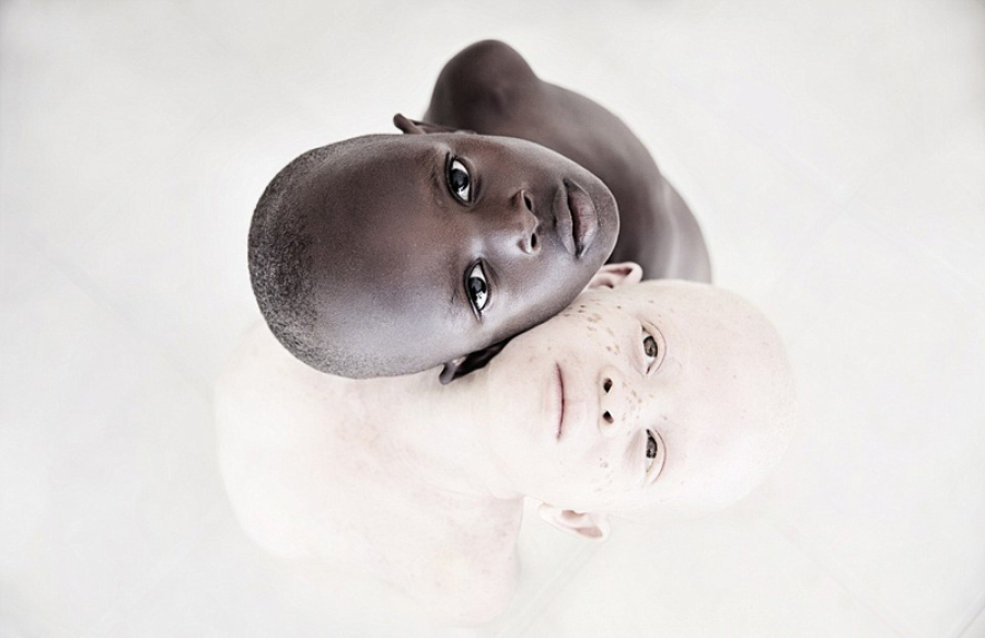 女摄影师拍非洲白化病患呼吁破除迷信