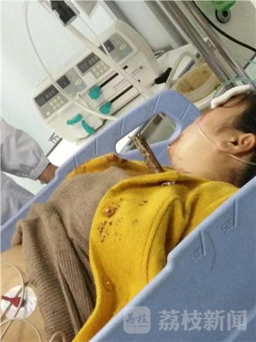 惊险!孕妇骑车摔倒树棍戳进脖子