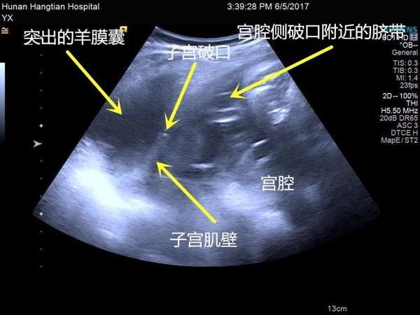 孕检时宝宝双脚踢出子宫,急救1小时母女脱险