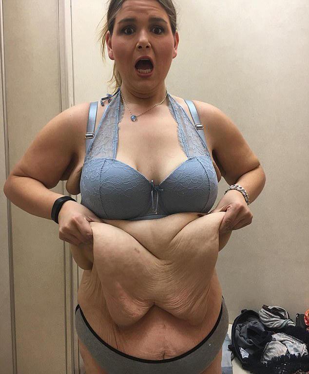 胖妞减肥190斤,留下20斤的赘皮如同泄气的气