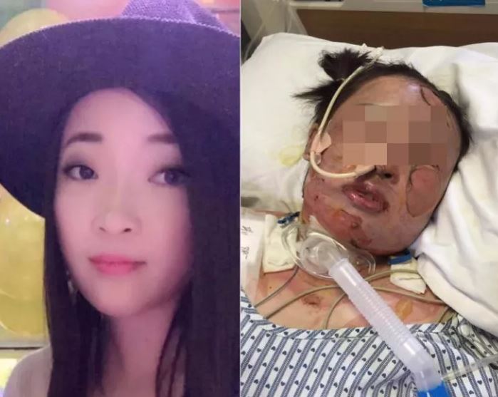 24岁漂亮女孩重度烧伤病危 母亲探望途中车祸身亡