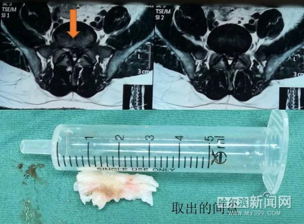 13岁少年久坐刷题累出腰间盘突出丨发病趋低龄,医生教