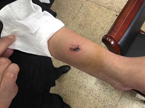南京一医院保安抱住轻生患者被咬下一块肉:只