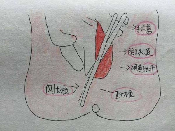 产妇顺产遭侧切,实习医生缝好了,主任过来拆了重新缝!