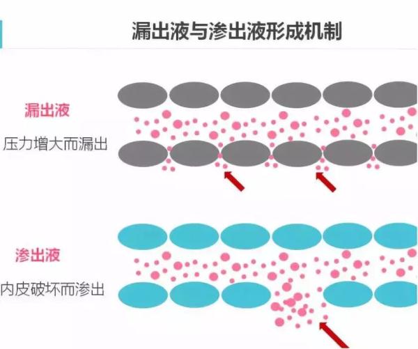 鉴别腹水性质很重要 一文教你鉴别技巧