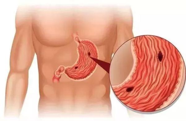 幽门螺杆菌最怕四种食物,长期坚持,四种胃病会离你更远! 幽门螺杆菌最怕四种食物,长期坚持,四种胃病会离你更远!