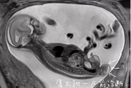 怀孕5个月突然发现腹中胎儿有条尾巴夫妻俩慌了结果