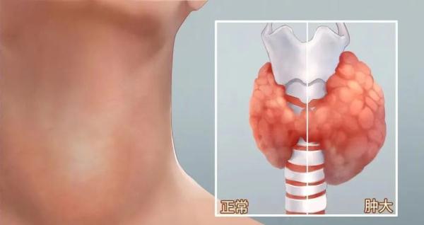 (图片来源:腾讯医典)常见的双侧甲状腺弥漫性病变有桥本氏甲状腺炎