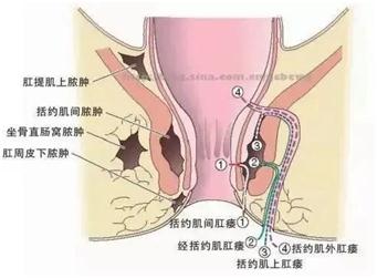 肛周脓肿指发生于肛门,肛管和直肠周围的急性化脓感染性疾病,多见于20