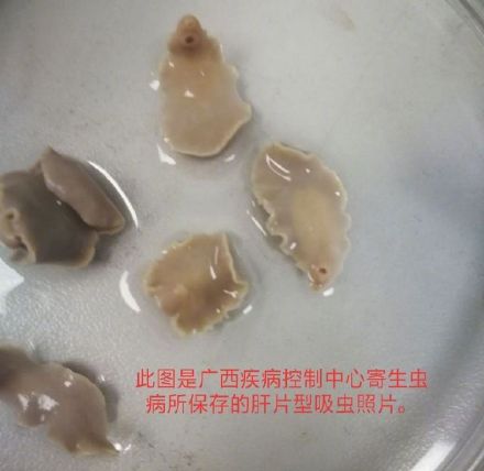 吃生鱼片患肝吸虫病_中国患肝一般能活几年_肝片形吸虫和姜片吸虫