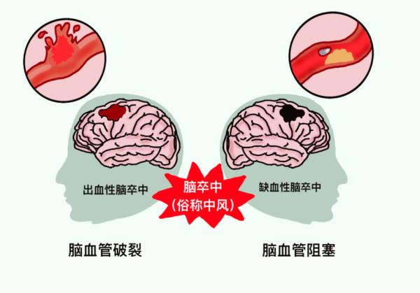 17,提示每5位死亡者中至少有1位因脑卒中死亡.