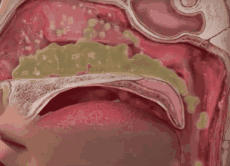 为什么有人一到冬天就犯鼻炎？