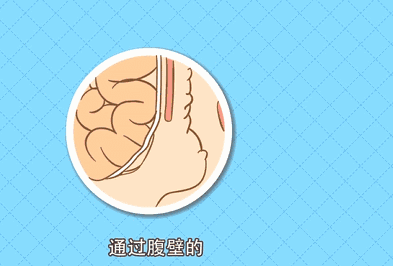 肚子出现肿块、鼓包？可能是腹股沟疝