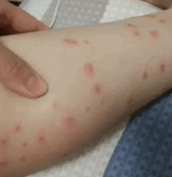 当心这小虫,有人被咬后进急诊!广东户外很常见 当心这小虫,有人被咬后进急诊!广东户外很常见