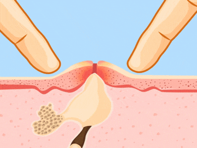 "身体缺啥脸上就长啥"真准吗?苦苦战"痘"的小伙伴快来看 → "身体缺啥脸上就长啥"真准吗?苦苦战"痘"的小伙伴快来看 →