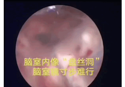 冰箱里的隔夜披萨，竟让她得上脑膜炎！这个杀手你认识它吗？