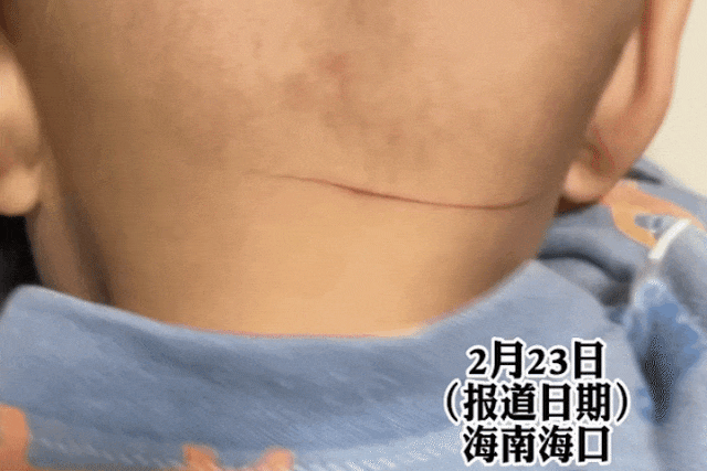 警惕!有人已被割伤脖子! 警惕!有人已被割伤脖子!