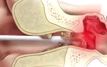 颅内感染、脑脊液从耳朵流出!一岁半娃鼓膜穿孔竟是因为…… 颅内感染、脑脊液从耳朵流出!一岁半娃鼓膜穿孔竟是因为……