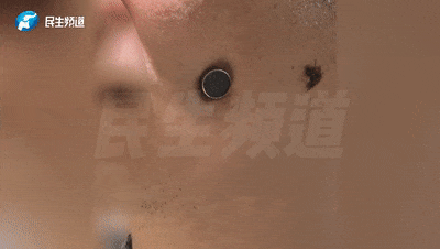 现实版“万磁王”？男子的脸竟能吸住磁铁！一查吓一跳