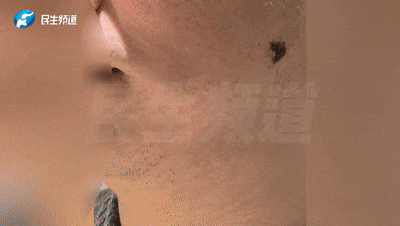 现实版“万磁王”？男子的脸竟能吸住磁铁！一查吓一跳