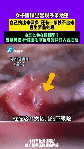 女子揉眼后拽出2条活虫,医生紧急提醒!有这些习惯的一定注意 女子揉眼后拽出2条活虫,医生紧急提醒!有这些习惯的一定注意