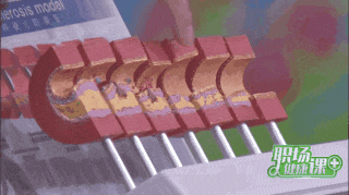 软斑块vs硬斑块,哪个更危险?做好3件事,血管年轻10岁! 软斑块vs硬斑块,哪个更危险?做好3件事,血管年轻10岁!