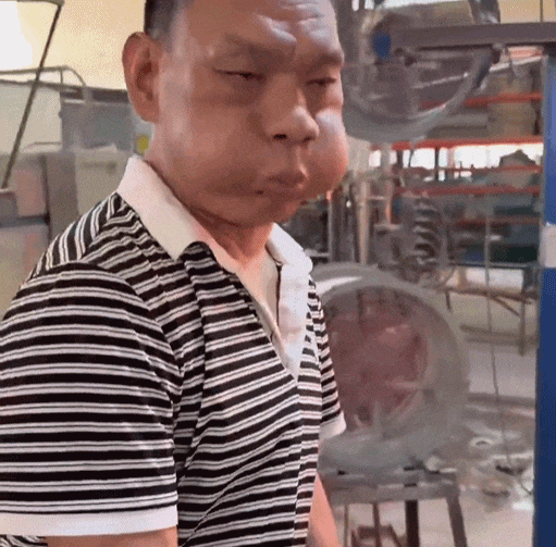 工作30年，男子面部严重变形，这些都是职业病