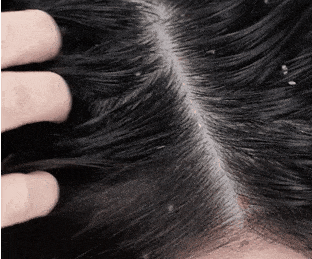 洗头后湿发入睡，会加重脱发