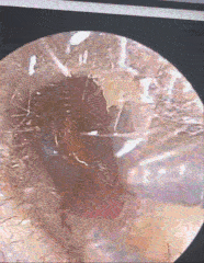 大爷耳朵突然钻心的疼！到医院检查，画面让在场的人倒吸一口凉气……