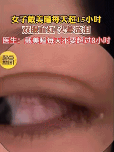 天天戴美瞳的人注意:你以为在变美?戴错,伤害不可逆! 天天戴美瞳的人注意:你以为在变美?戴错,伤害不可逆!