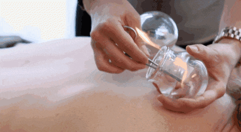 本想养生却进了医院！女子拔火罐被烧伤，酒精起火如何灭？