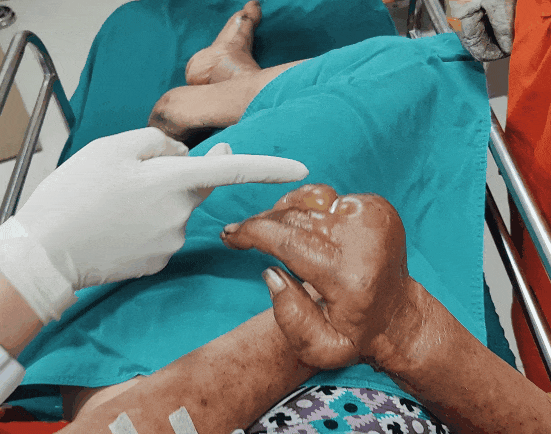 老人手部“爬”满水泡，状如鸽子蛋！医生紧急求助消防员