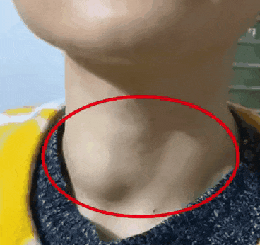 12岁“乖乖女”突然暴躁易怒、性格反常！医生：不是青春期叛逆，是身体在“报警”