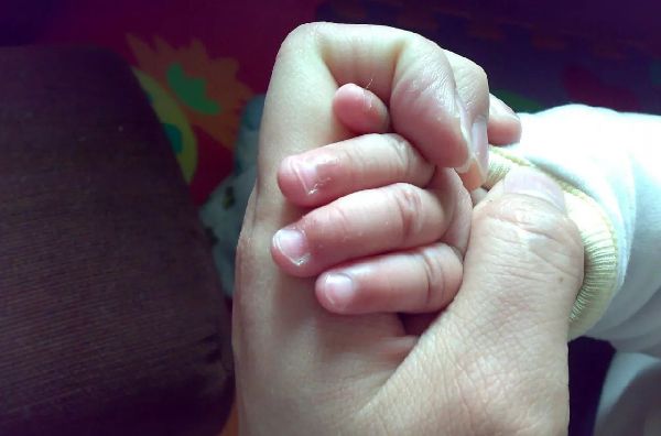 手上长倒刺是缺维生素？两码事儿