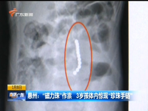3岁男童体内惊现“珍珠手链” X光片结果让人大吃一惊