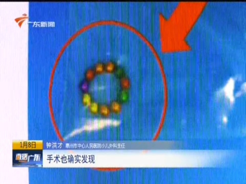 3岁男童体内惊现“珍珠手链” X光片结果让人大吃一惊