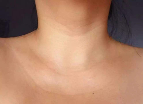 小斑块大问题,颈动脉斑块怎么修? 小斑块大问题,颈动脉斑块怎么修?