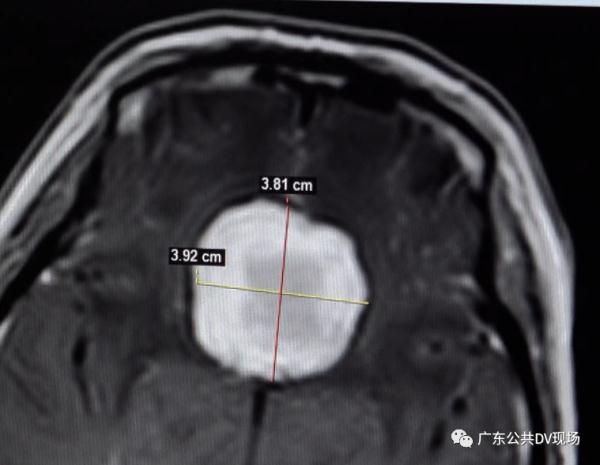 恶性脑瘤诊断证明照片图片