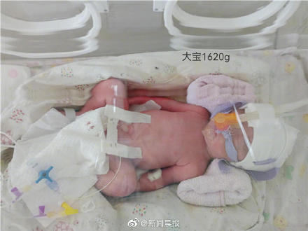 全国首例确诊新冠孕妇诞下三胞胎