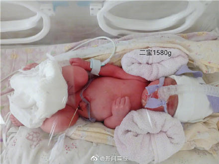 全国首例确诊新冠孕妇诞下三胞胎