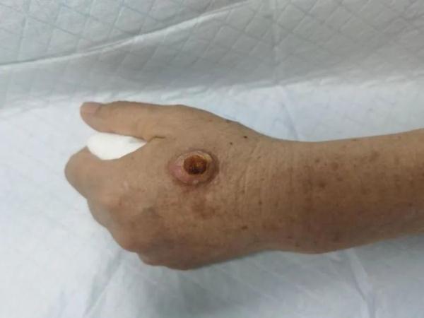因膏药反复刺激，湖南70岁奶奶手上的小肿物竟恶化成癌