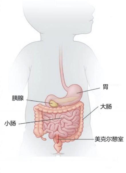 深圳12岁男孩拉了一马桶血进了picu,罪魁祸首是肠子里多出的一块肉