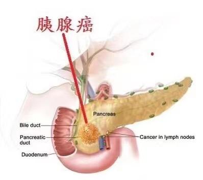 胰腺癌诊断证明图片图片