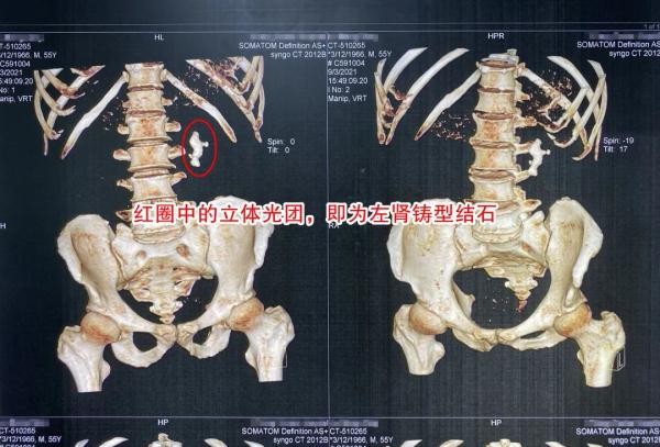 痛风肾超声图片图片